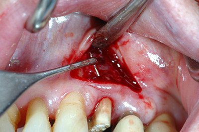 Chirurgia orale (prima)