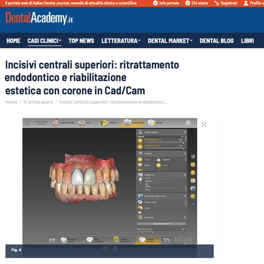 Incisivi centrali superiori: ritrattamento endodontico e riabilitazione estetica con corone in Cad/Cam